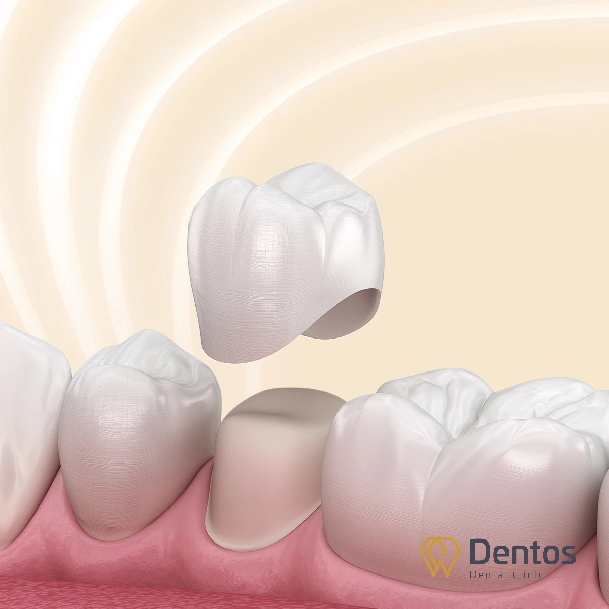 Răng tạm bảo vệ răng thật trong giai đoạn chờ răng sứ hoàn thiện